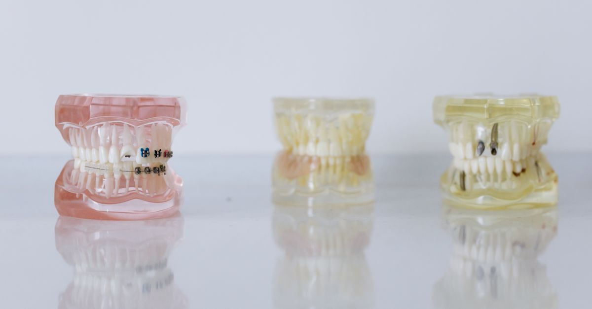 découvrez comment l'assurance pour implants dentaires peut couvrir vos soins, réduire vos coûts et vous offrir une tranquillité d'esprit optimale.